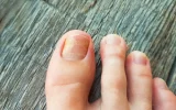 Treat Nail Fungus