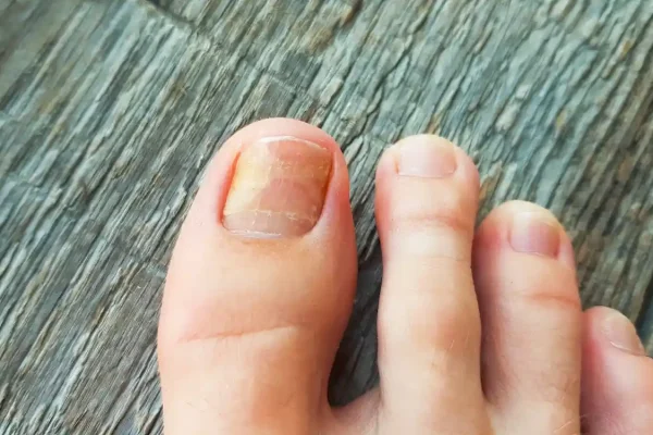 Treat Nail Fungus