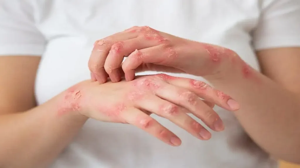 How Do You Stop Psoriasis From Spreading