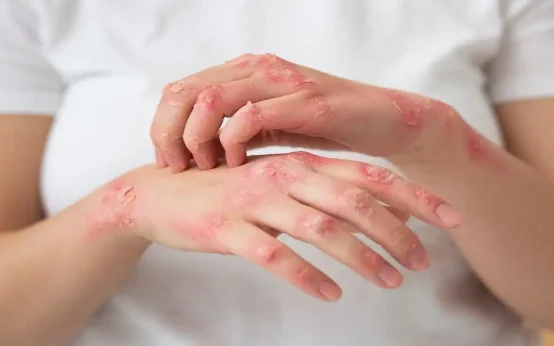 How Do You Stop Psoriasis From Spreading