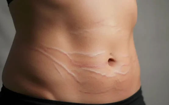 in how much time stretch marks to fade