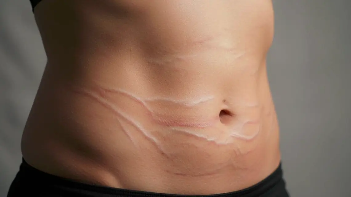 in how much time stretch marks to fade