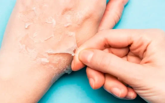 exfoliate peeling skin after sunburn