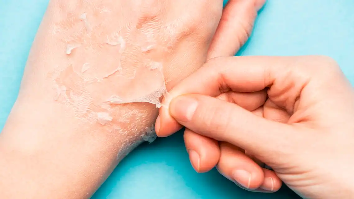 exfoliate peeling skin after sunburn