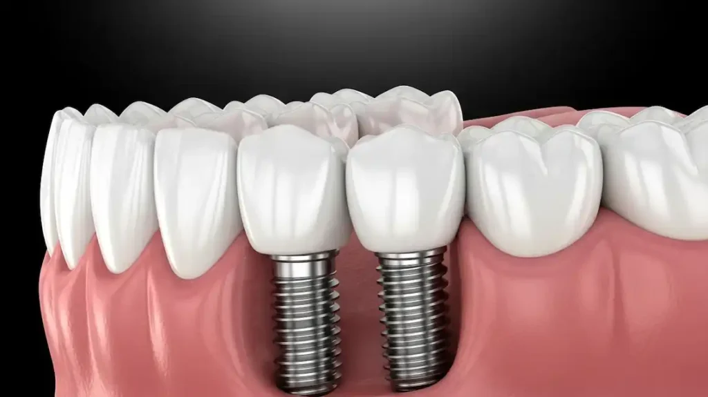 advantages of dental implants