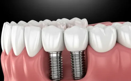 advantages of dental implants